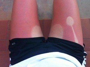 worst-sunburns-bad-sunburns